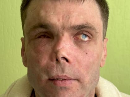 Пластические хирурги из Екатеринбурга вернули лицо военному