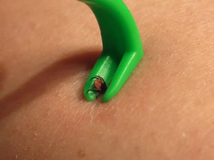 В травмпункте Первоуральской больницы снят первый клещ