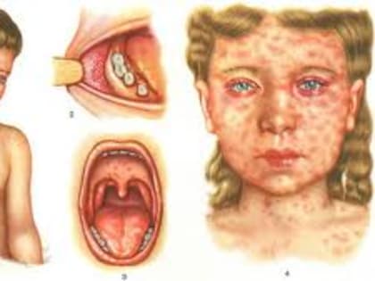 «О результатах эпиднадзора Серовского ТО за заболеваемостью корью на территории ГО Верхотурский»