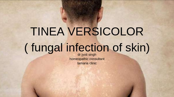 HOMEOPATHIC TREATMENT OF FUNGAL INFECTION OF SKIN!!