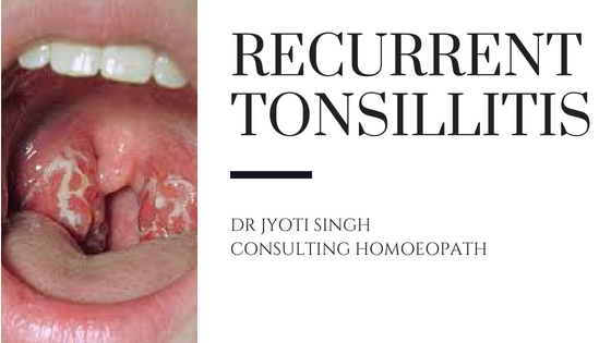 Treat recurrent tonsillitis in your child with homeopathy!