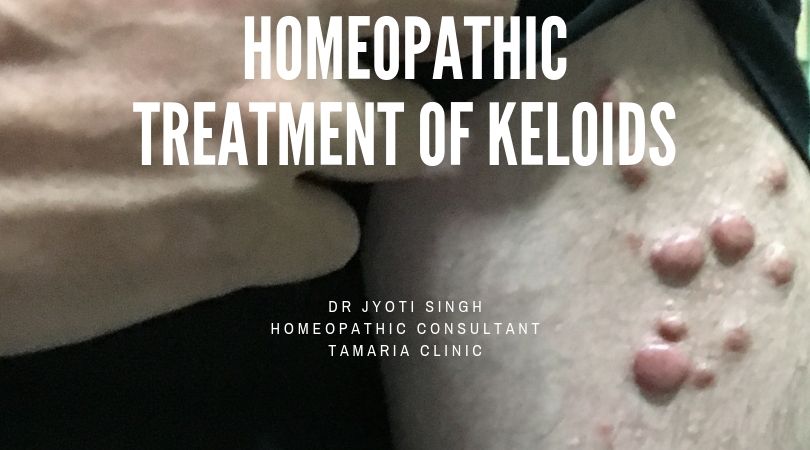 HOMEOPATHIC TREATMENT OF KELOIDS