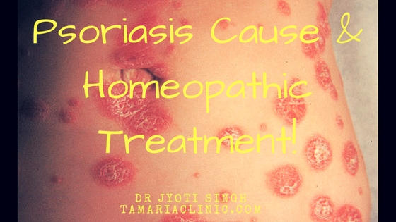 Psoriasis Cause & Homeopathic Treatment!