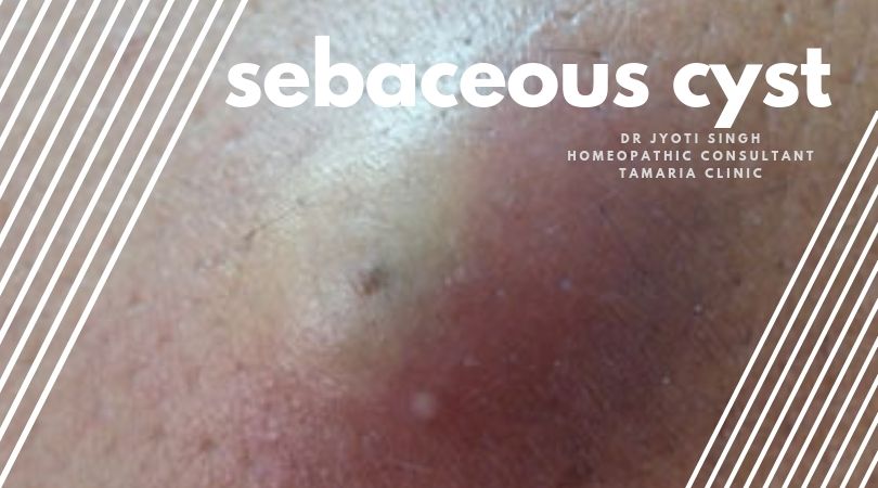 HOMEOPATHIC TREATMENT OF SEBACEOUS CYSTS!!