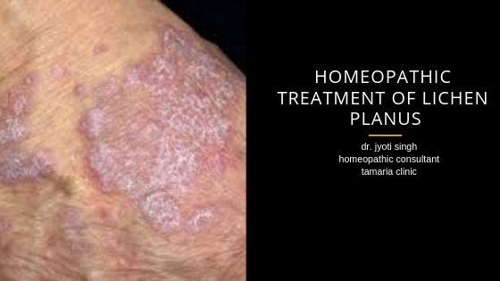 HOMEOPATHIC TREATMENT OF LICHEN PLANUS