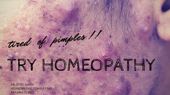 TREAT ACNE WITH HOMEOPATHY