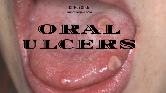 ORAL ULCERS