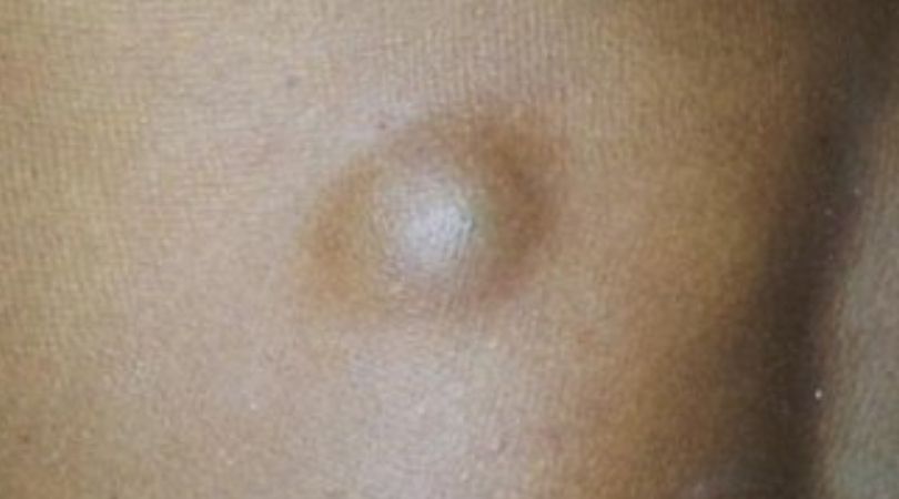 Best Homeopathic Treatment For Sebaceous Cyst Lump Cyst In Vasant Kunj Treatment In Delhi Tamariaclinic Com