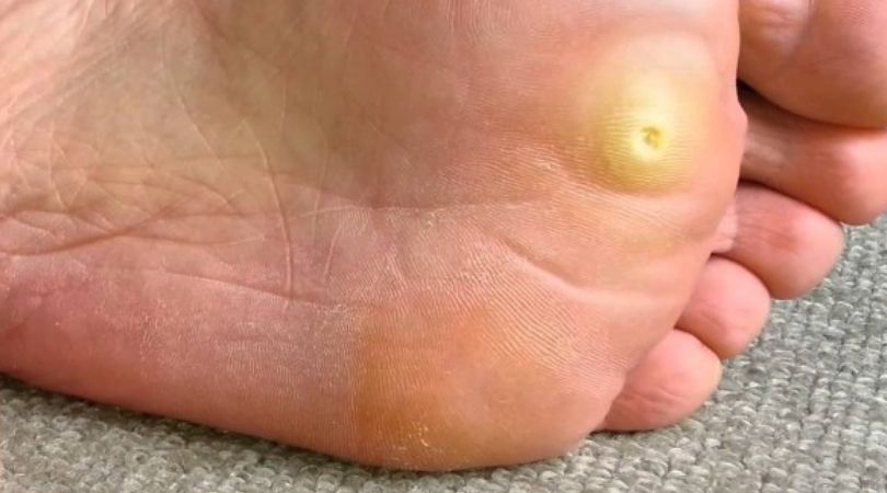corn foot treatment homeopathic