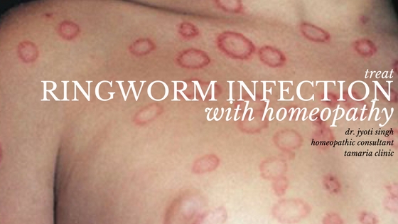 TREAT RINGWORM WITH HOMEOPATHY!!