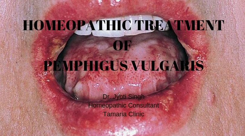 PEMPHIGUS VULGARIS