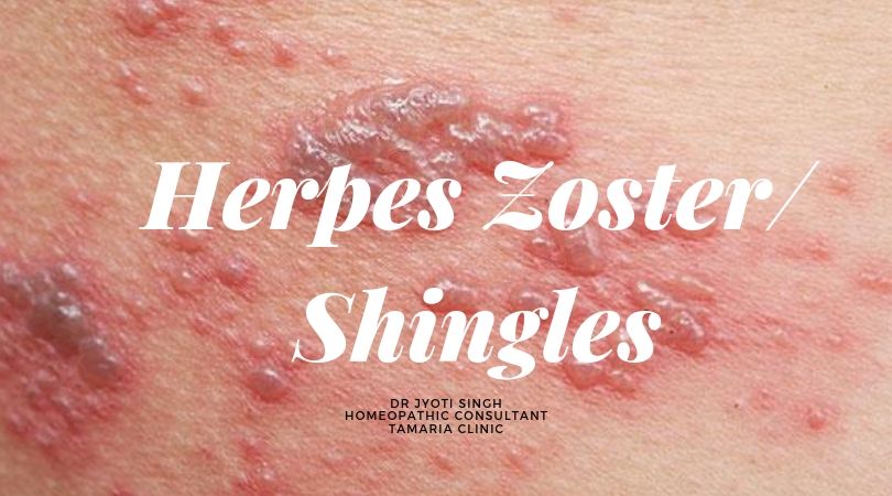 HERPES ZOSTER/ SHINGLES