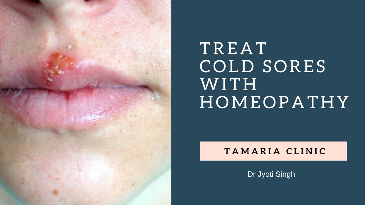 COLD SORES