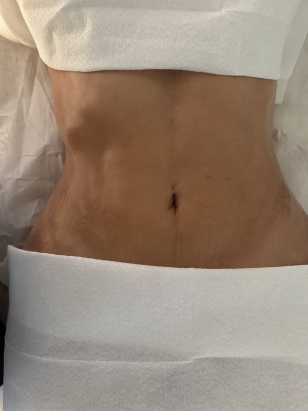 Resultado de drenagem linfática pós-operatória, recuperação ao domicílio em Lisboa