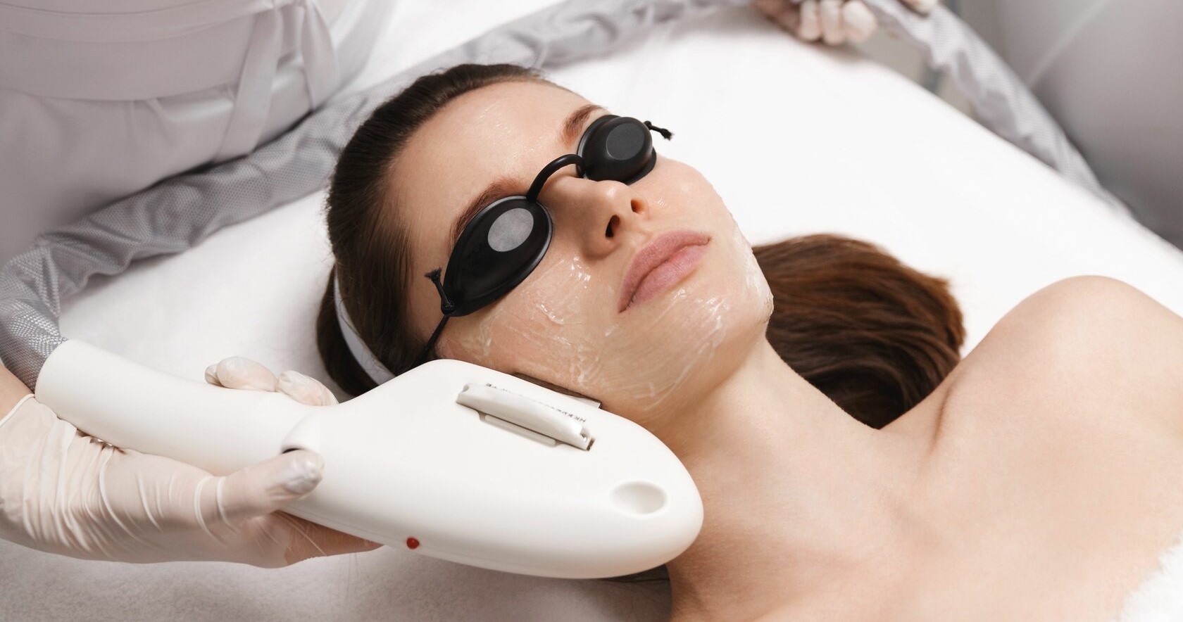 Лазерне ELOS лікування акне