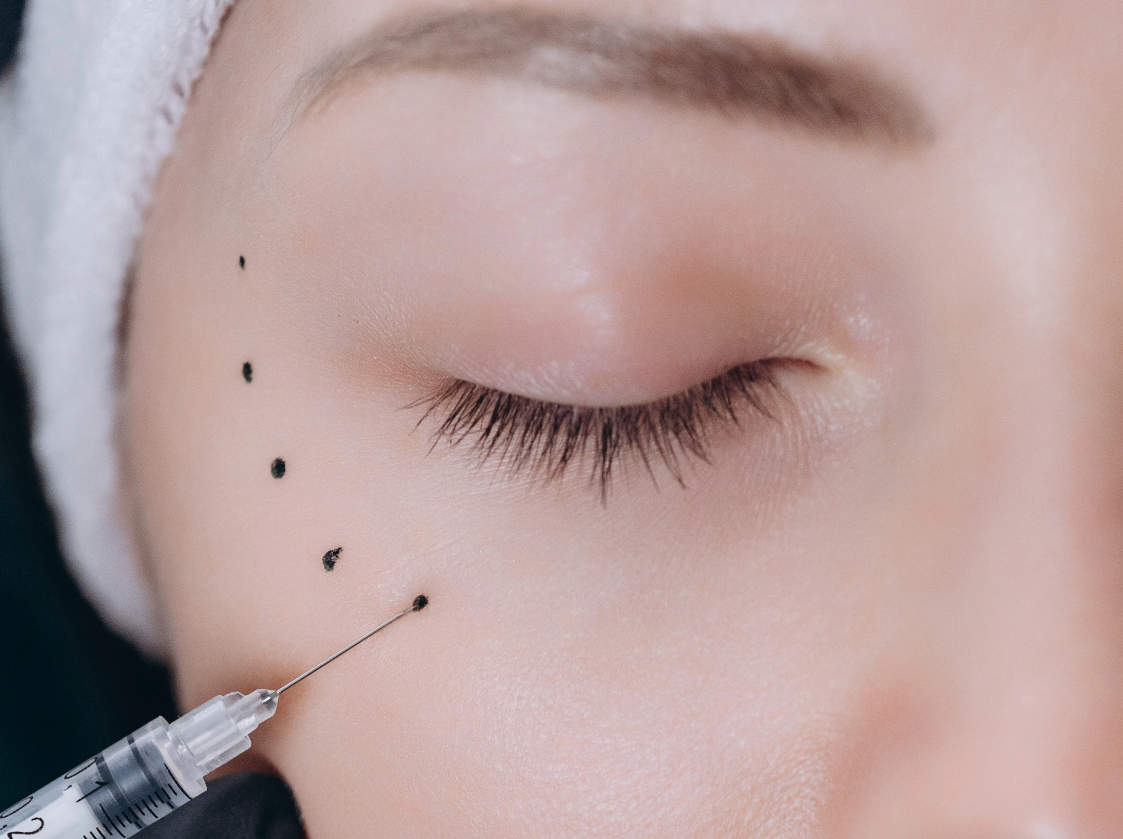 RADIESSE - векторний ліфтинг обличчя