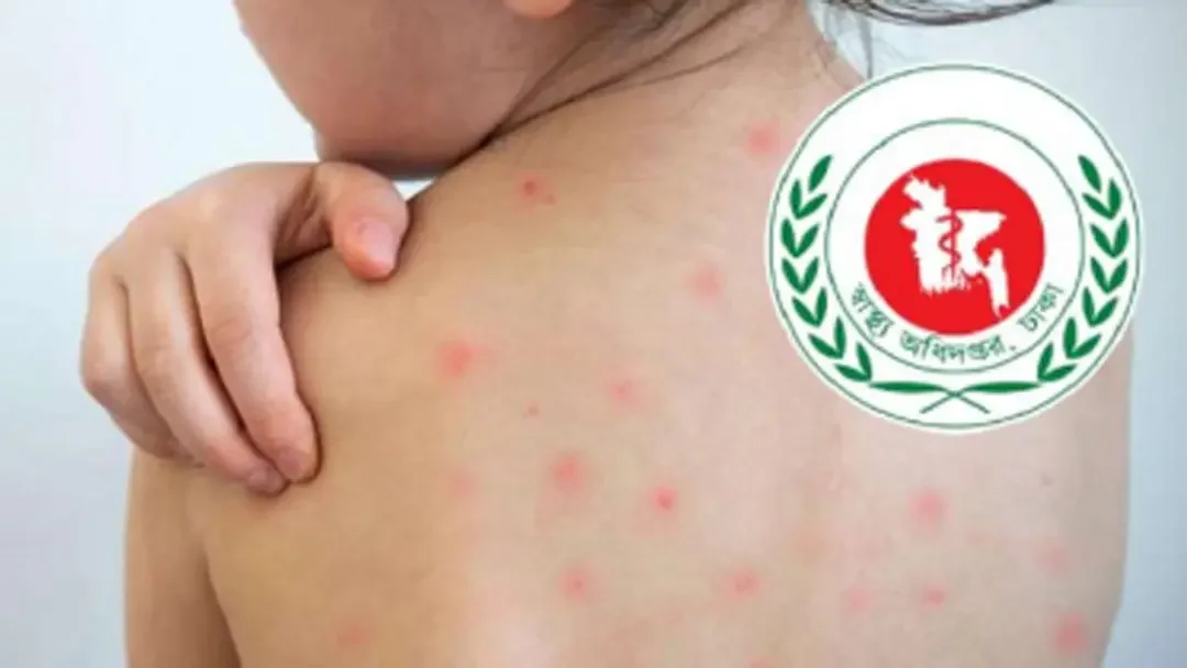 হাম ও হামের উপসর্গ নিয়ে ১০ জনের মৃত্যু