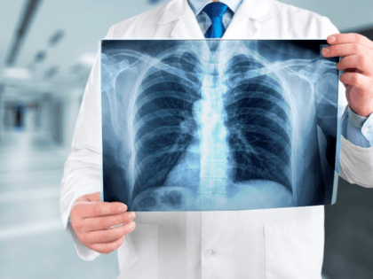 В Полесске проведут акцию по профилактике рака лёгких