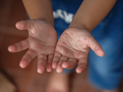 В Калининградской области зафиксированы случаи энтеровирусной инфекции