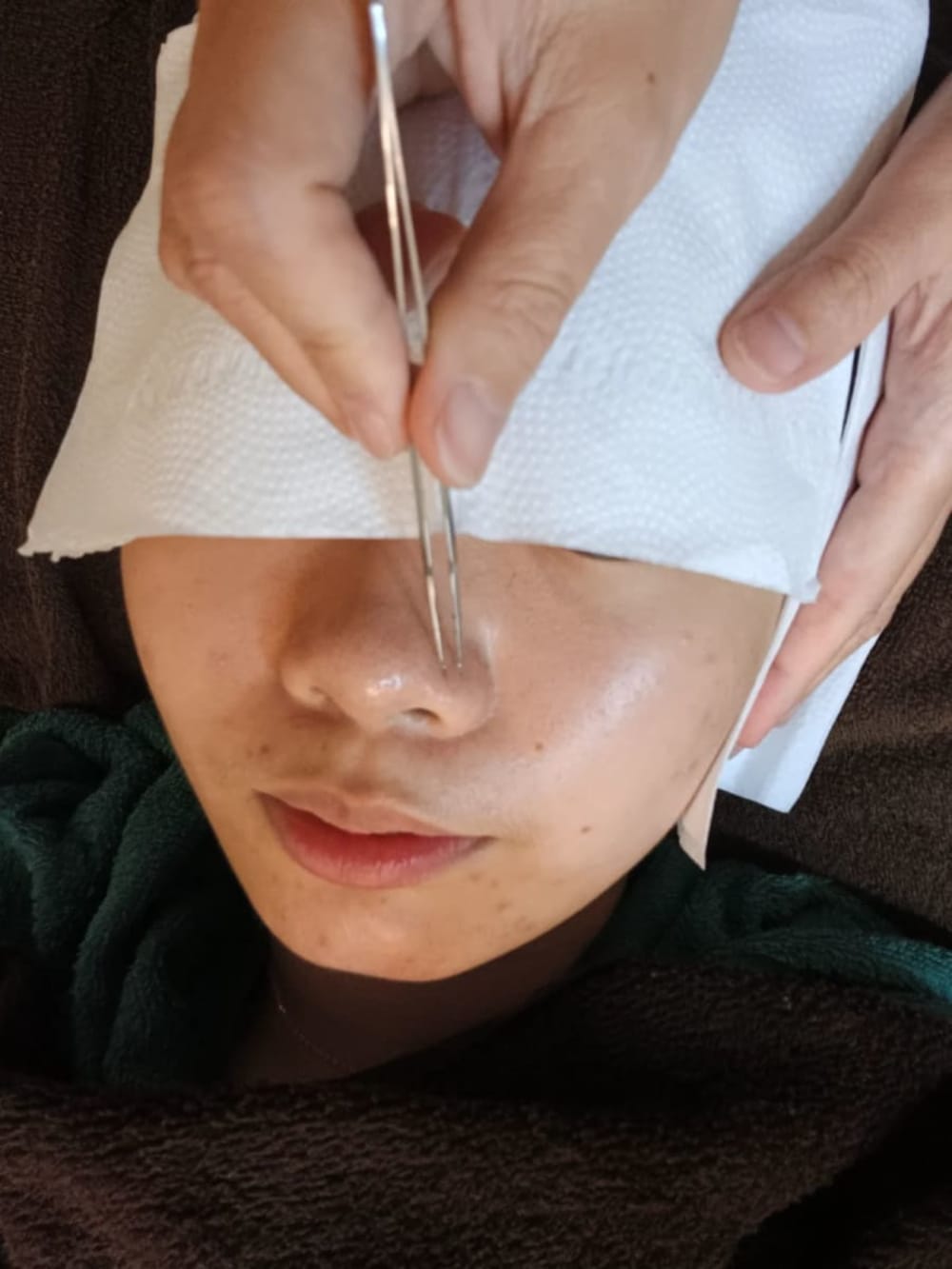 皮膚管理 粉刺清除