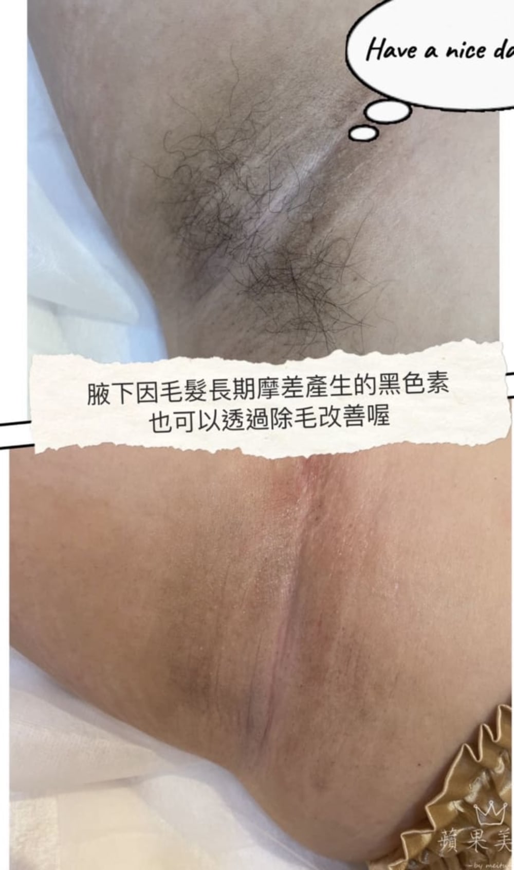 熱蠟私密毛髮全身毛髮整理