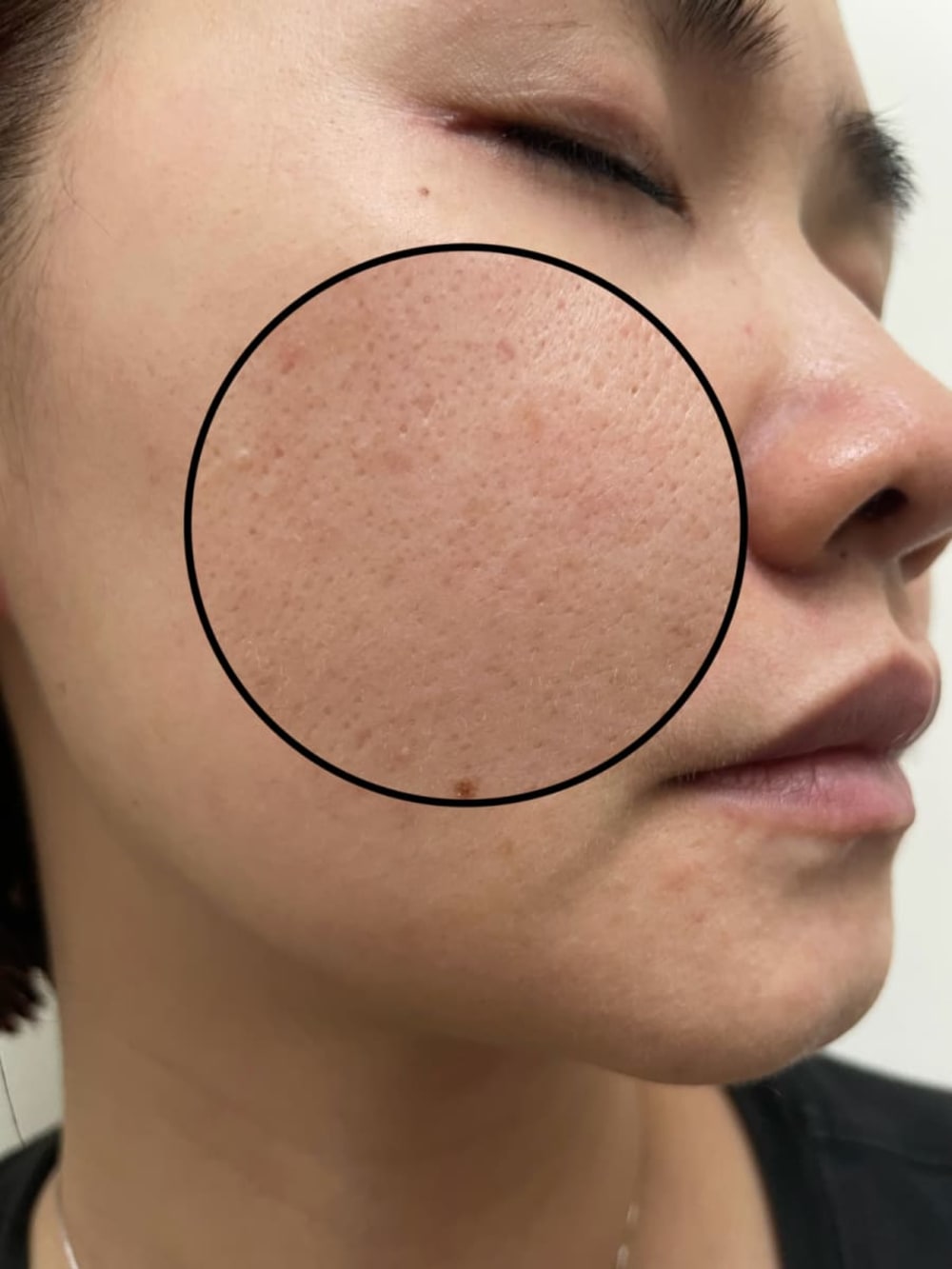 	白藻針｜讓膚況慢慢穩定、毛孔更細緻