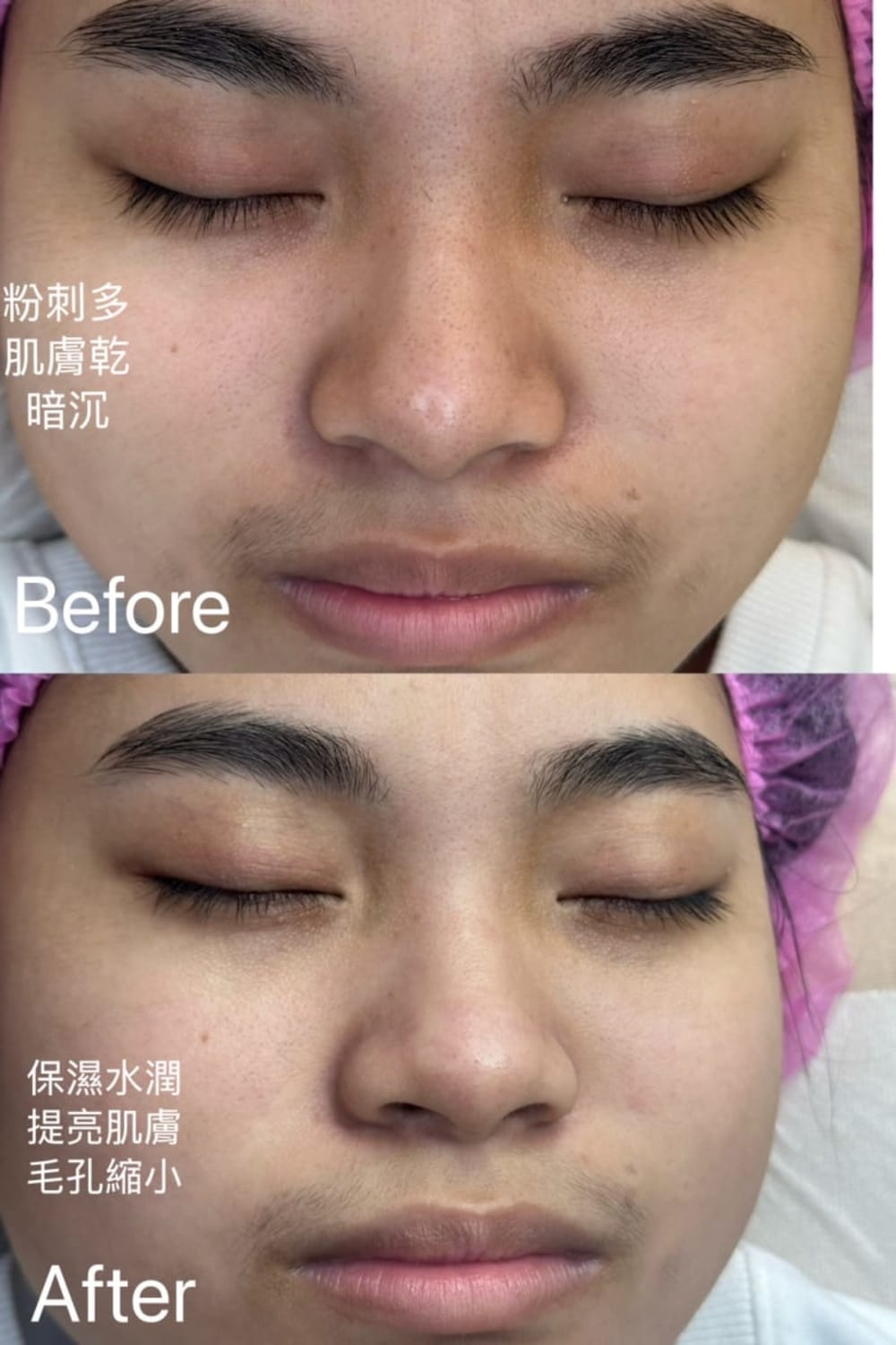 粉刺清乾淨補水,肌膚就透亮啦!