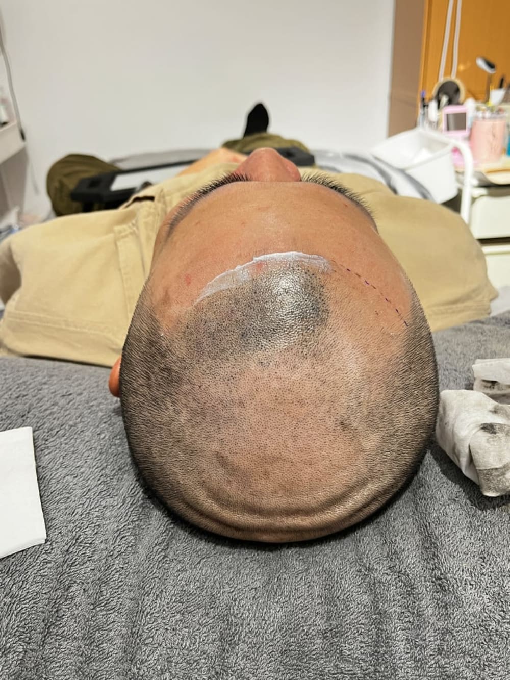 smp毛囊增密