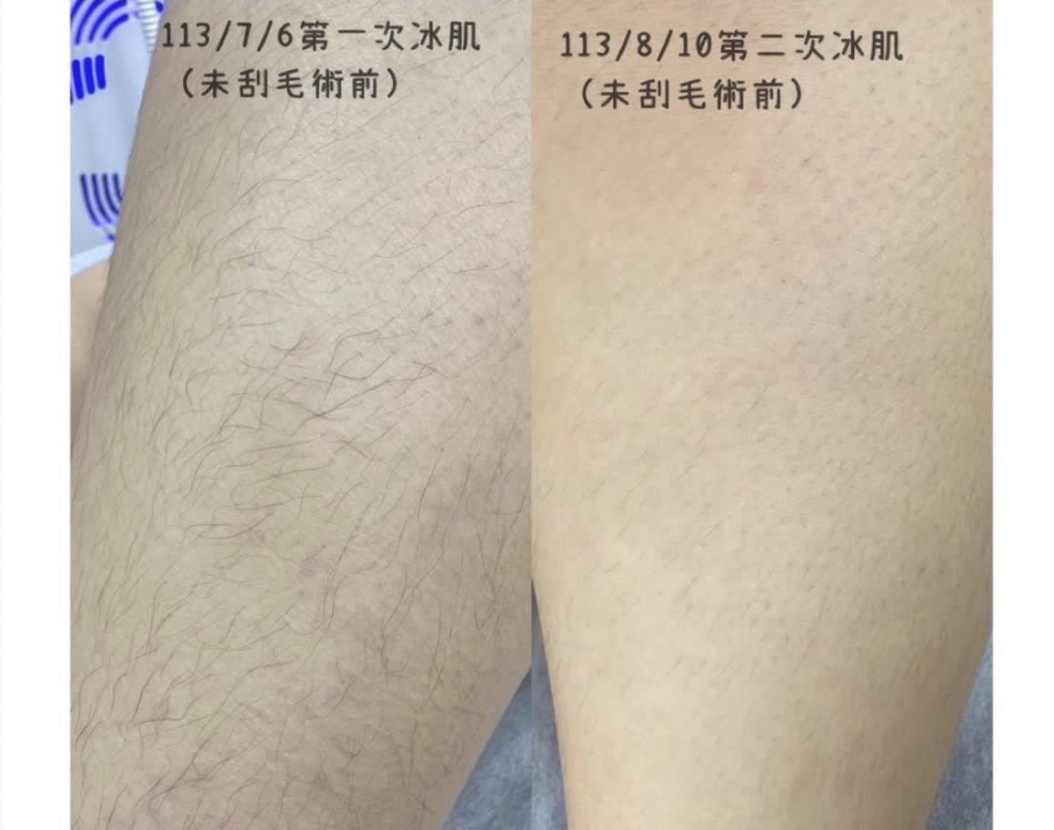 新北市鶯歌區美睫作品 — Yuna老師 小腿除毛