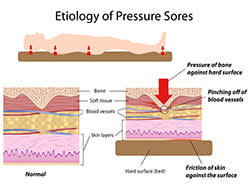 Graphic of the etiology of pressure sores