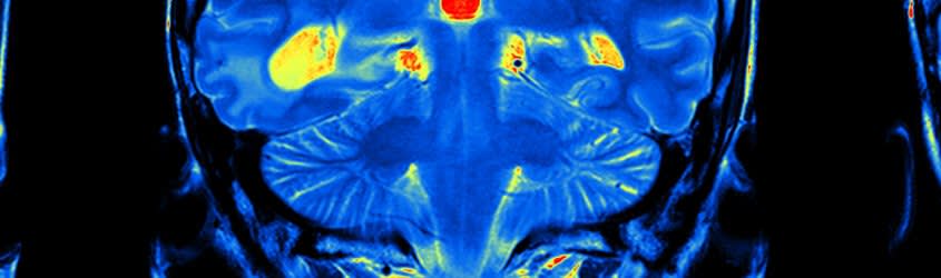 Brain MRI.
