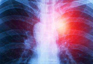 Chest x-ray showing a red area