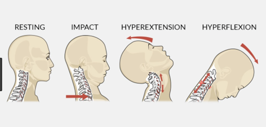 Virginia car accident whiplash injury