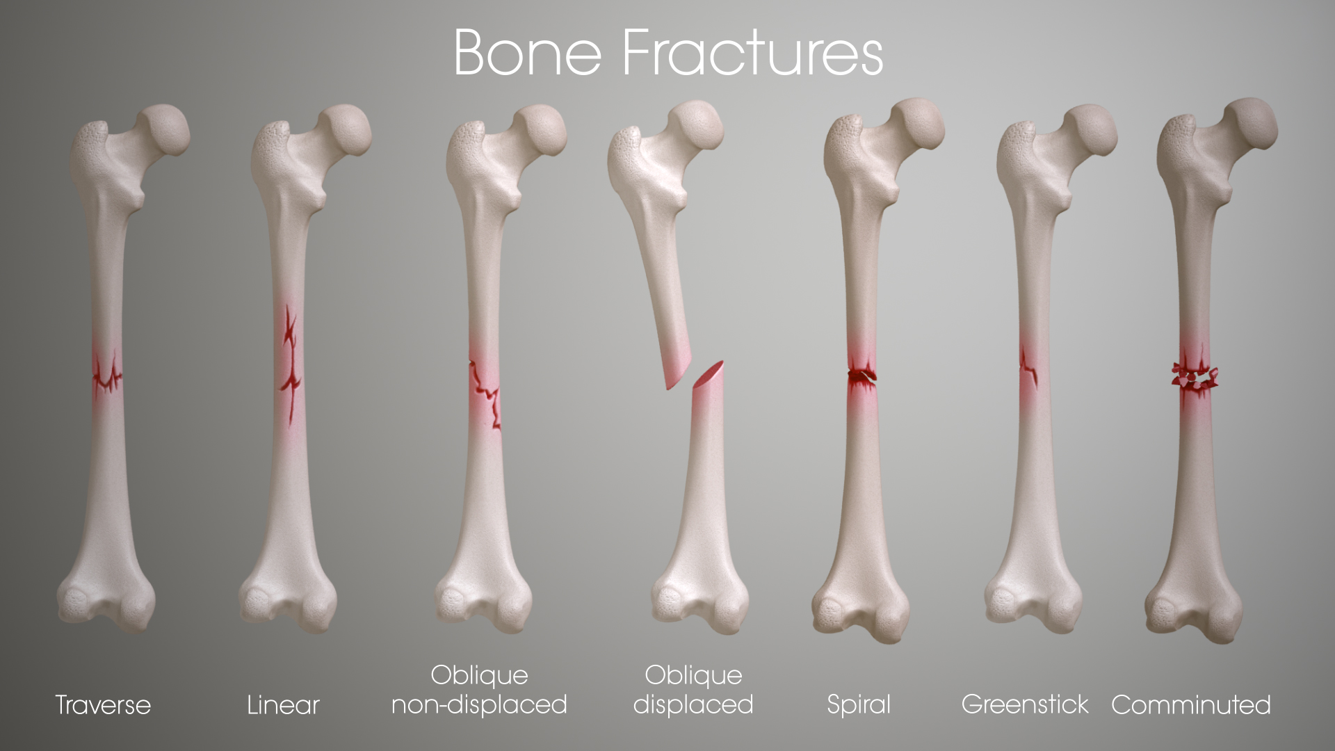 Car Accident fractures