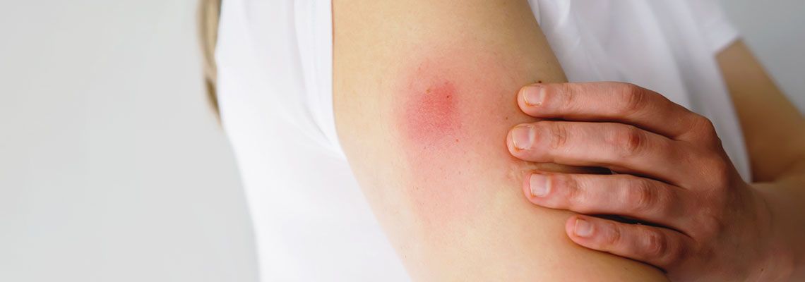 Swollen arm after vaccination
