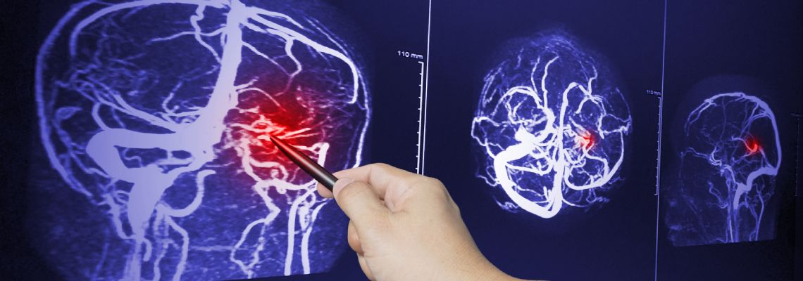 Doctor pointing at brain MRI