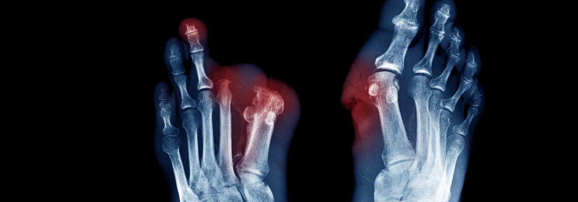 Xray image of diabetic foot ulcer show Joints Collapse and toes amputation