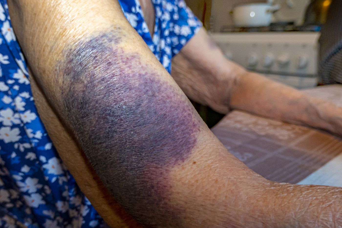 elderly person's arm with large purple bruise
