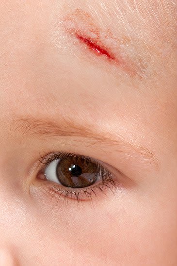 Scratch on Baby's Forehead