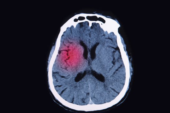 Brain MRI