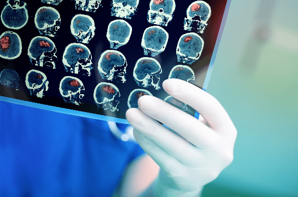 doctor holding brain scan images with white glove