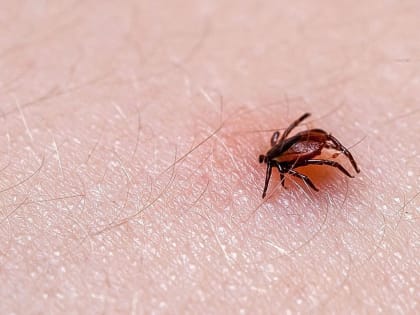 Уже 73 первоуральца пострадали от укусов клещей