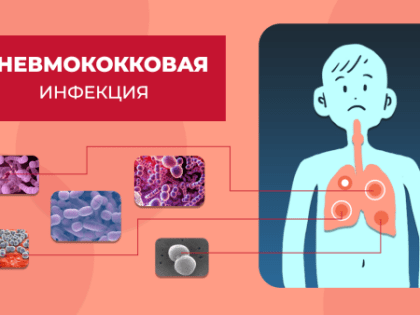 Пневмококковая инфекция