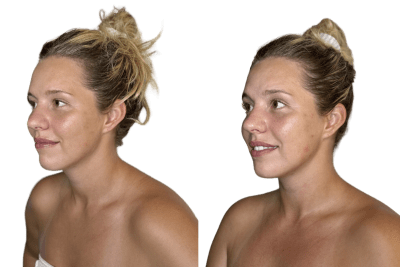 Buccal facial before and after, three-quarter view, Murray Utah