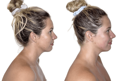 Buccal facial before and after, right profile, Murray Utah