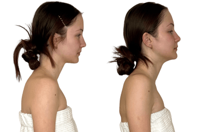 Buccal facial before and after, right profile, Murray Utah