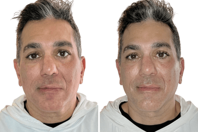 Buccal facial before and after, front view, Murray Utah