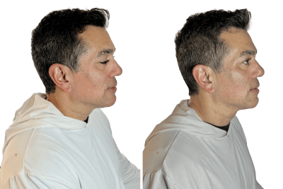 Buccal facial before and after, right profile, Murray Utah