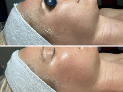 Korean Aqua Peel before and after, right profile view, Murray Utah