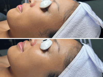 Korean Aqua Peel before and after, left profile view, Murray Utah